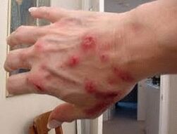 Pápulas en la piel con helmintiasis
